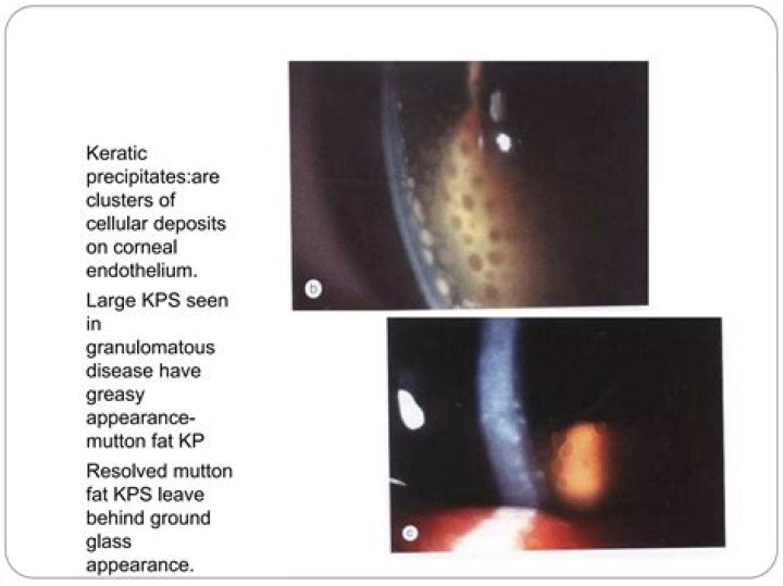 Atlas Entry MuttonFat Keratic Precipitates (KP)