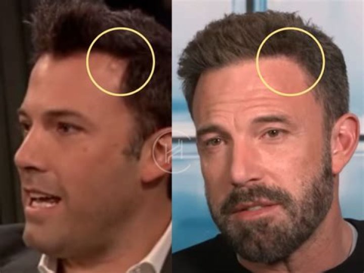 Ben Affleck Hair Transplant Hair Loss & Technical Analysis