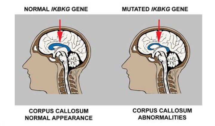 Corpus Callosum Function, Definition, Location and FAQs