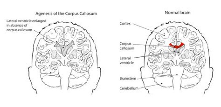 Corpus Callosum What Is It, Location, Function, and More Osmosis