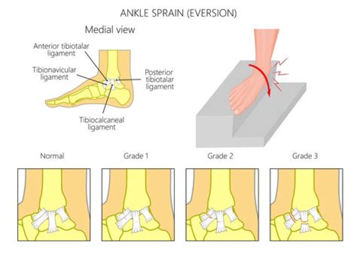 Deltoid Ligament Sprain How to Treat a Sprain of the Deltoid Ligament