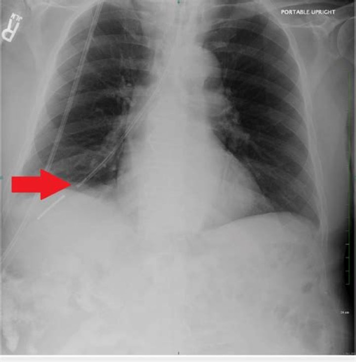 Dobhoff Tube Placement X Ray 2 The tube continuing straight below