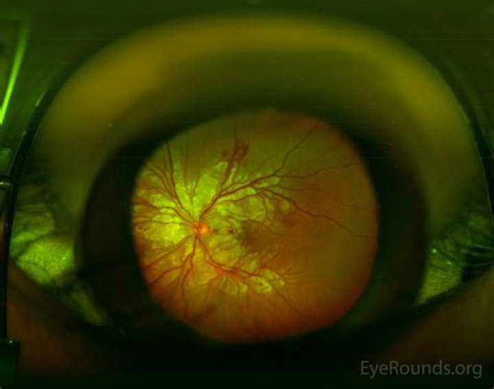 EyeRounds Glossary
