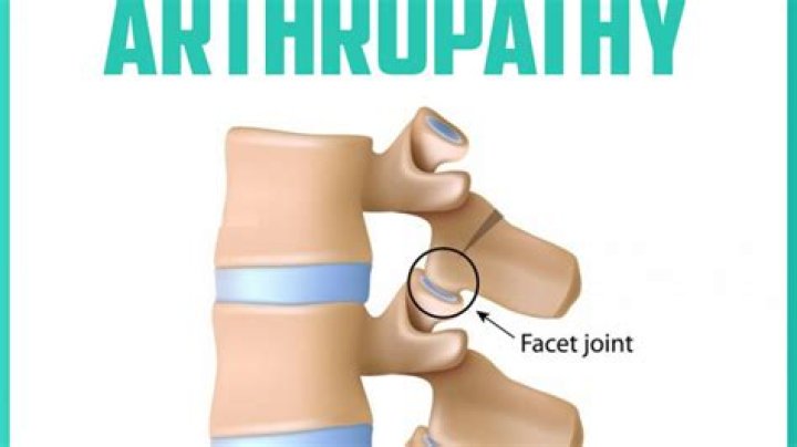 Facet Joint Arthropathy Sports Medicine Review
