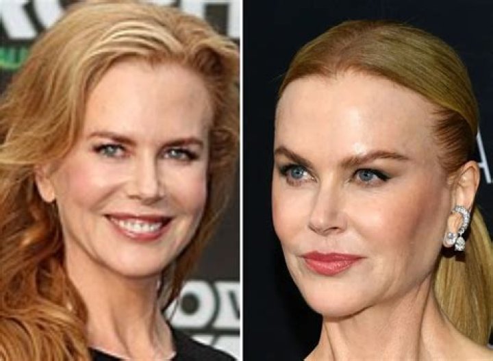 Has Nicole Kidman had cosmetic surgery? Celebrity