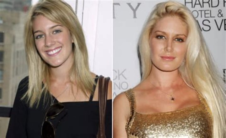Heidi Pratt Plastic Surgery Before And After