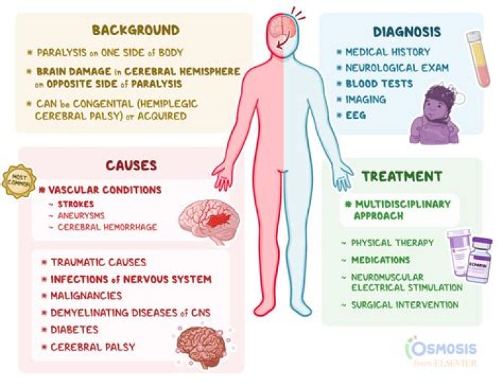 Hemiplegia What Is It, Causes, and More Osmosis