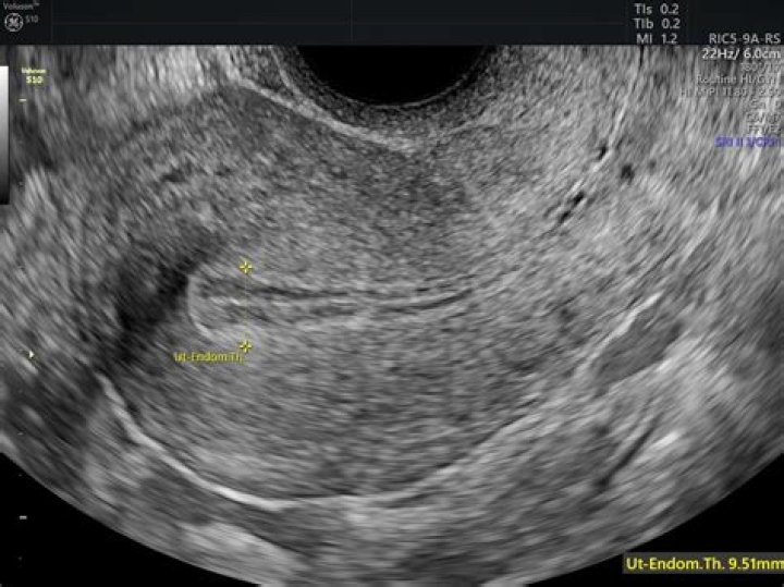 How Progesterone Levels May Impact IVF Pregnancy Empowered