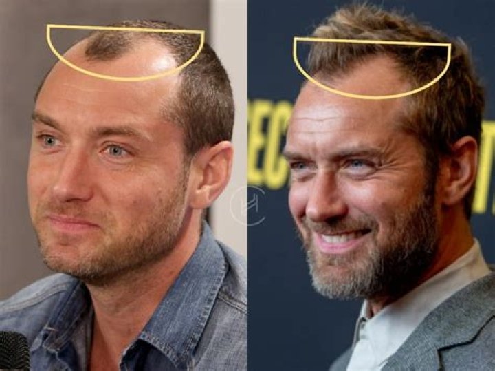 Jude Law Hair Transplant
