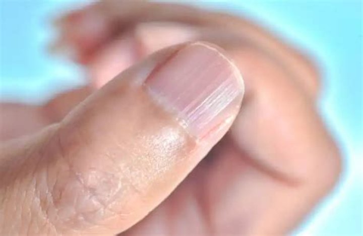 Lines On Your Fingernails, Do You Have Them? What Do They Mean? Blog