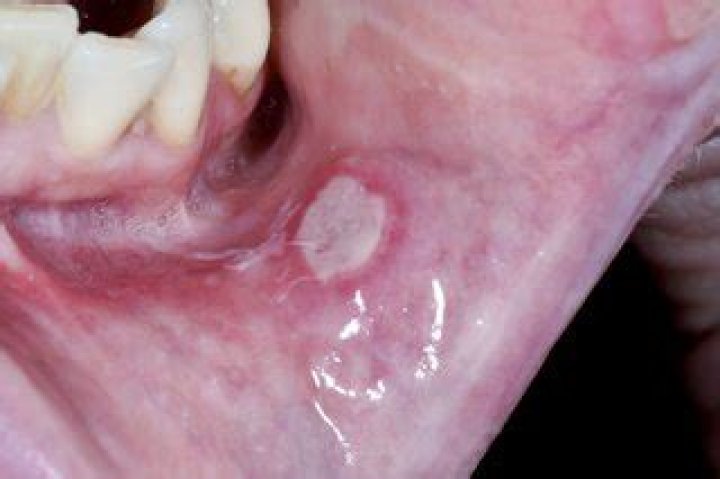 Mouth ulcers NHS