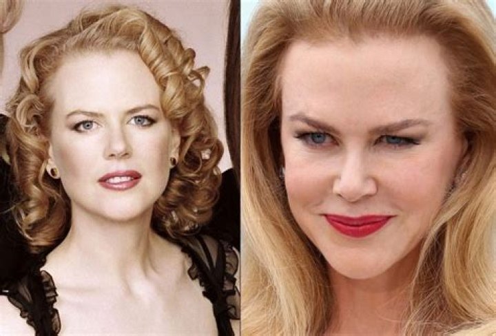 Nicole Kidman plastic surgery (26) Celebrity plastic surgery online
