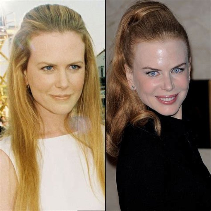 Nicole Kidman Plastic Surgery Celebrity Plastic Surge vrogue.co