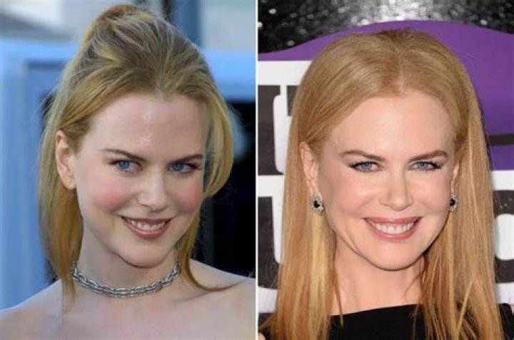 Nicole Kidman Plastic Surgery Photo Details