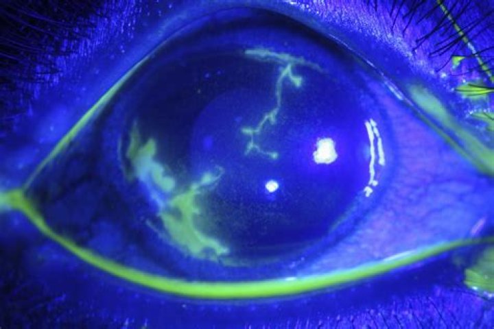 PHFI CEHJ &raquo; Herpes simplex infection of the eye an introduction