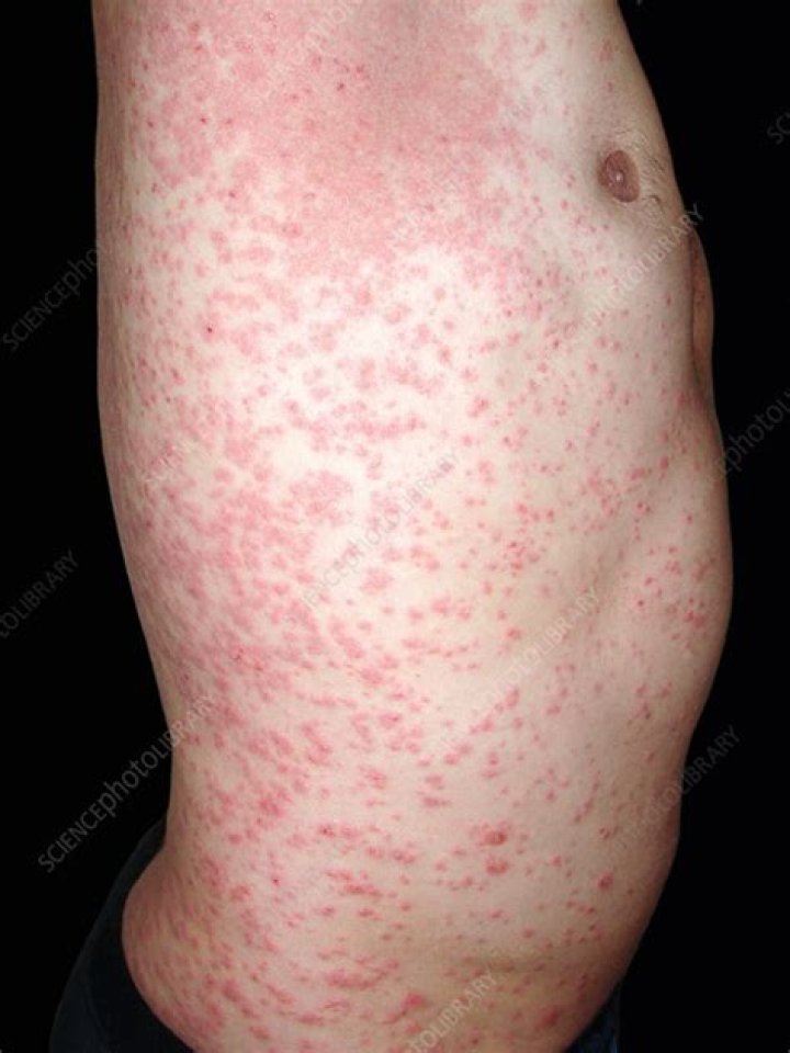 Pityriasis Rosea Legs
