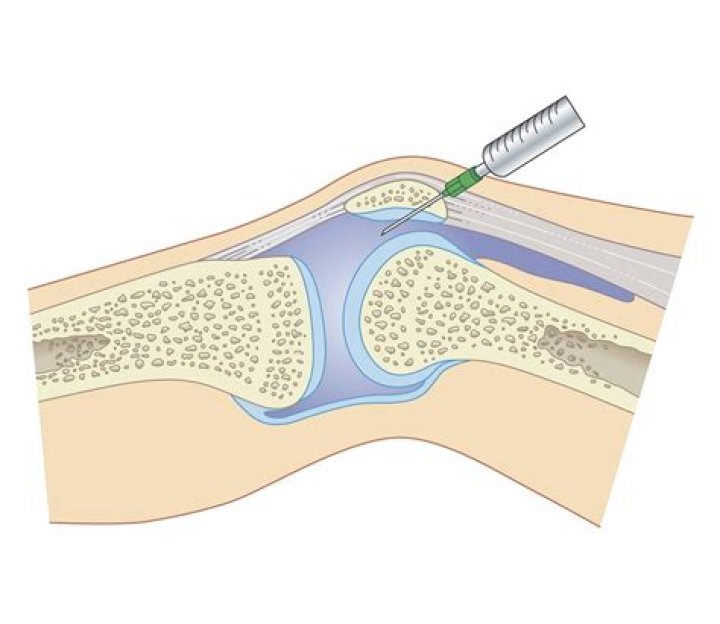 Synovial Fluid Cell Counts Do Not Accurately Differentiate Arthritis