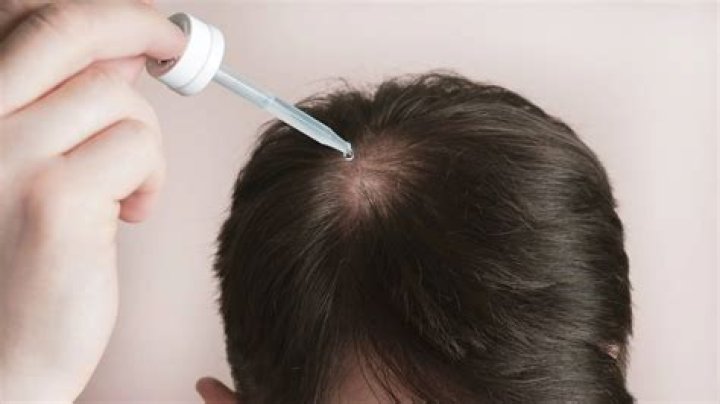 The Ultimate Guide To Gasly Hairlines: Causes, Treatments, And Prevention