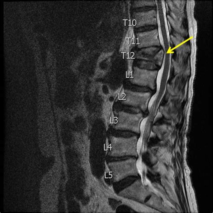 Thoracic Spine Compression Fractures Vertebra Plana