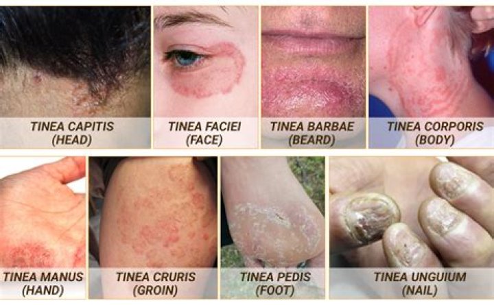 Tinea Manuum Symptoms, Causes & Treatment