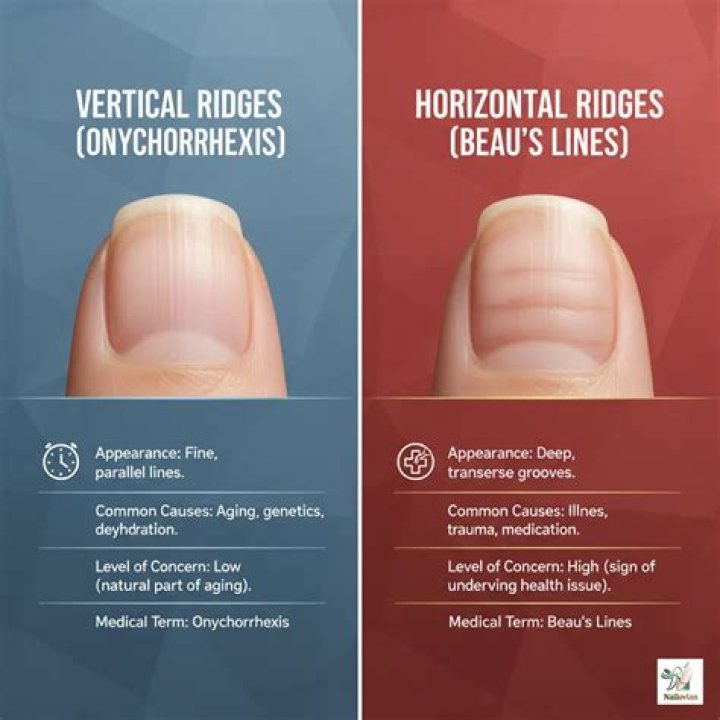 Uncover The Truth: Horizontal Ridges On Nails Explained