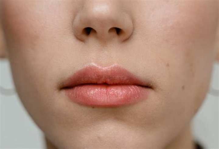 What Is Blood Blister In Mouth Causes And Treatment
