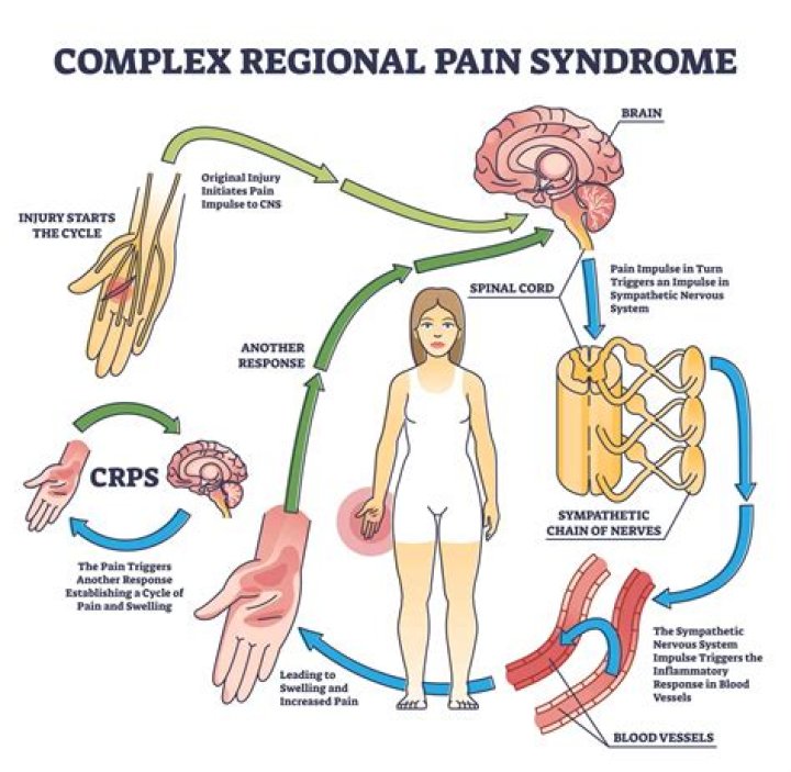 Why Does CRPS Spread? Kairos Restorative Medicine in TX